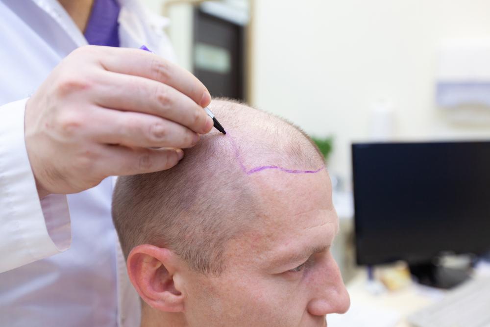 Why Do Hair Transplants Fail? What Is The Success Rate? | ReHair Istanbul
