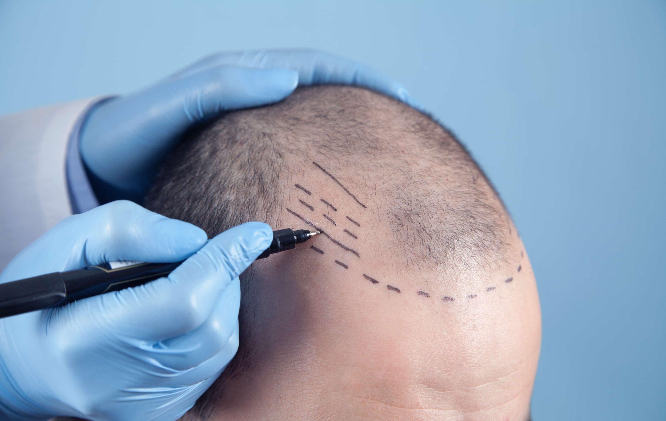 Exercise After Hair Transplantation Surgery | ReHair Istanbul