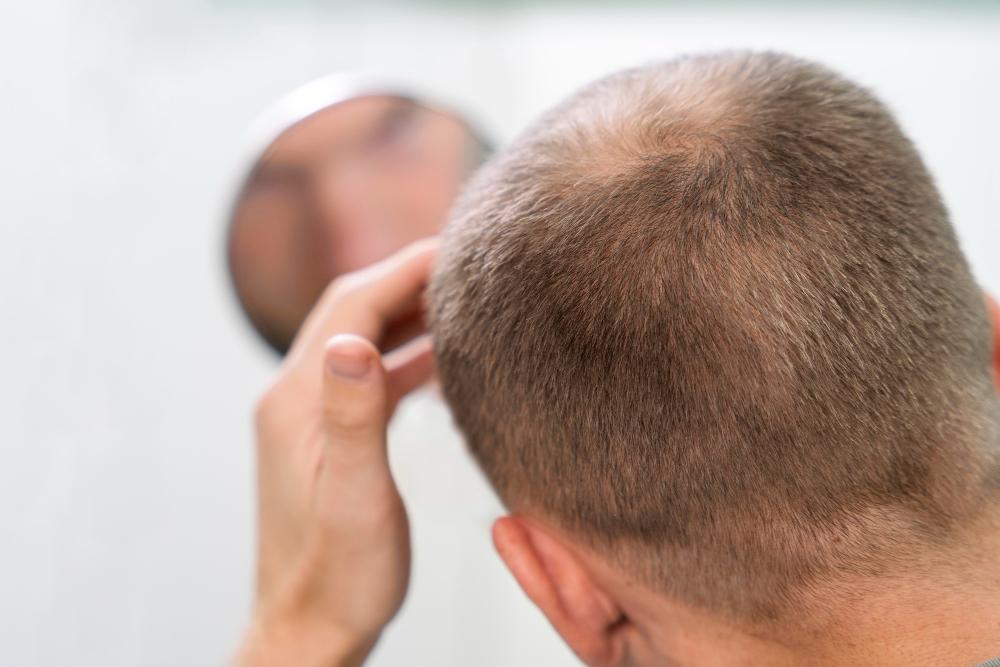 Hair Transplant Cost