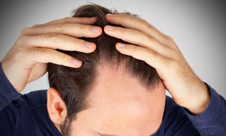 Alopecia (Hair Loss) - Skin Disorders - Merck Manuals Consumer Version