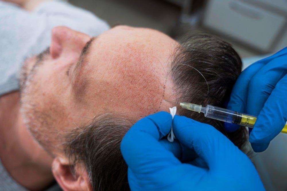 man getting hair loss treatment min