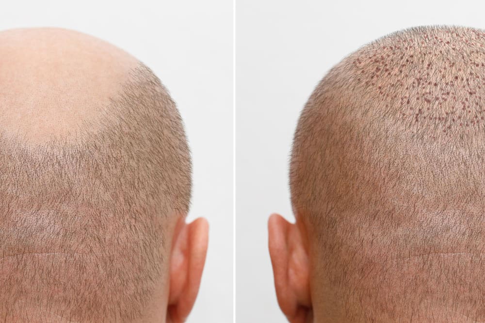 after hair transplant bg