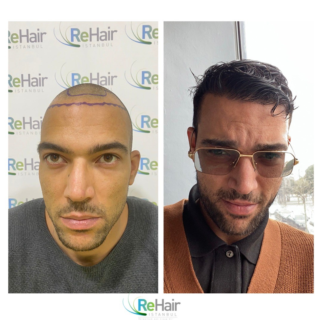 before-after-1