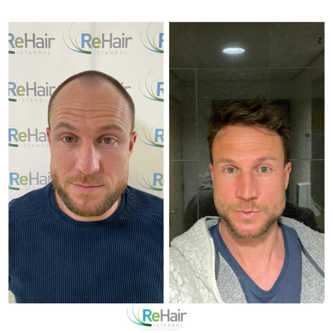 before-after-2