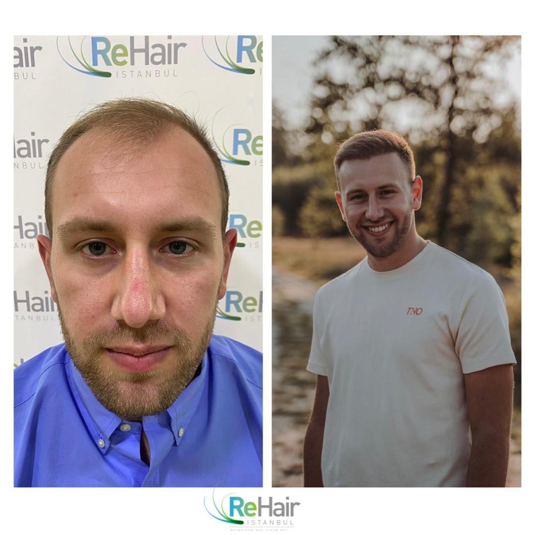 before-after-3
