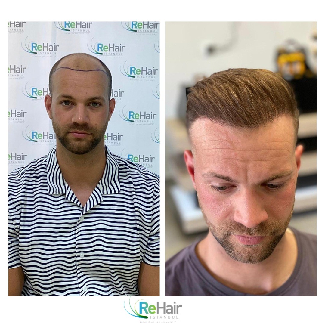 before-after-5