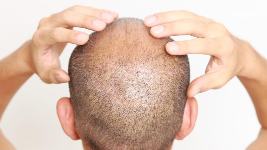 cheveux convalescence 15