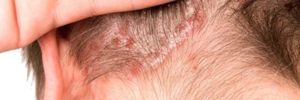 Seborroisch Eczeem shampoo