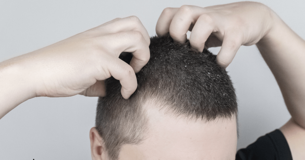 shampoo voor jeukende hoofdhuid
