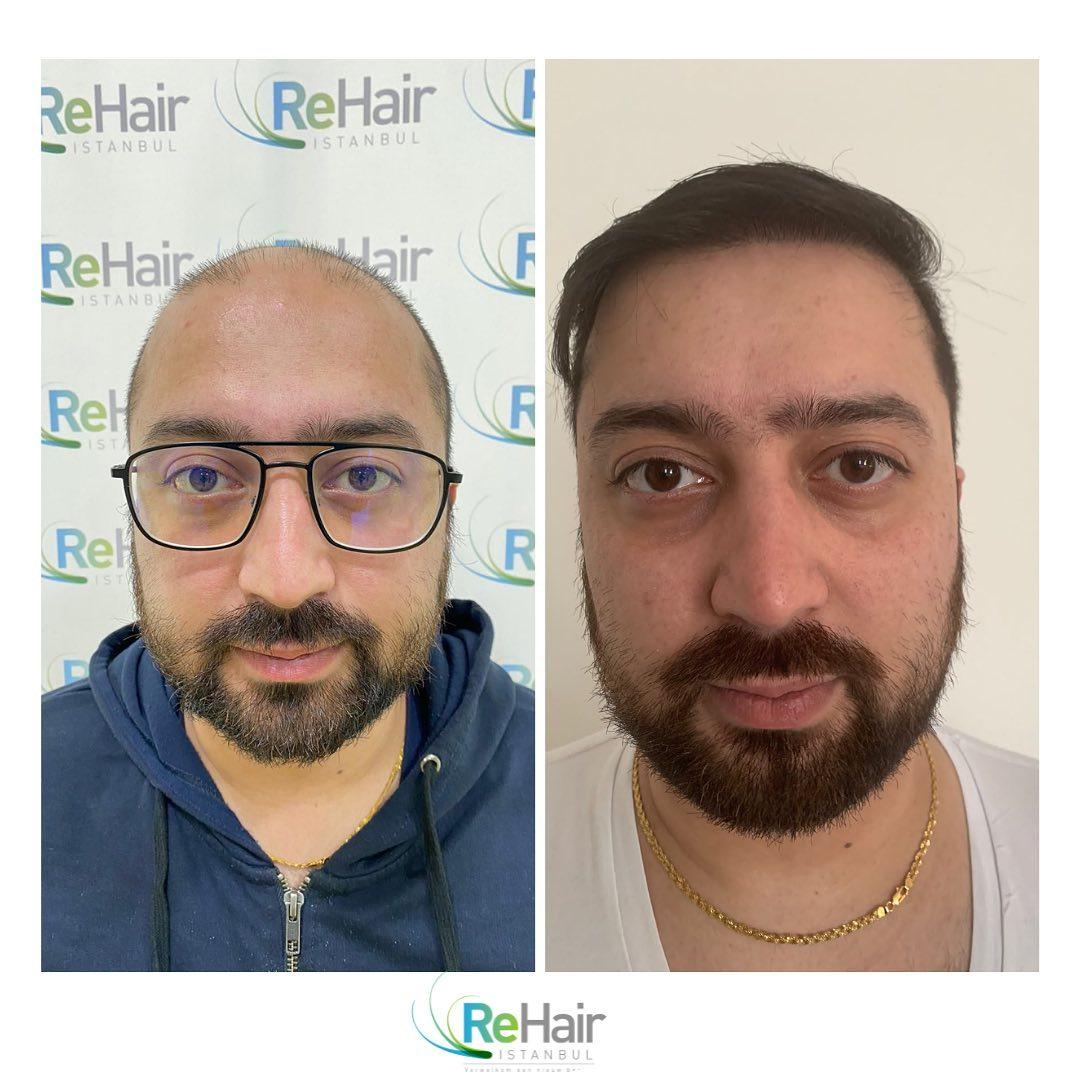Haartransplantatie resultaat voor en na — 12 maanden