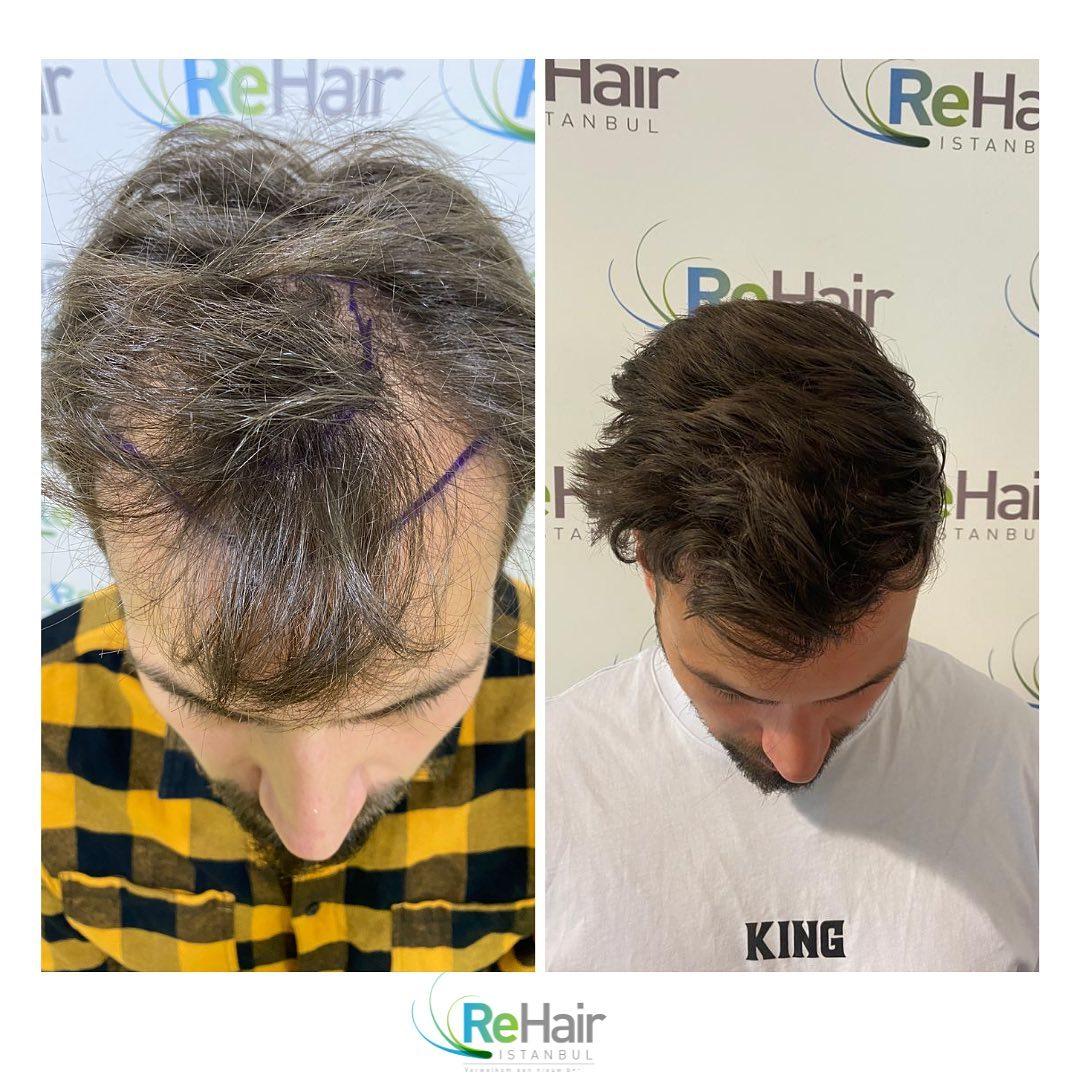 Haartransplantatie resultaat voor en na — 12 maanden