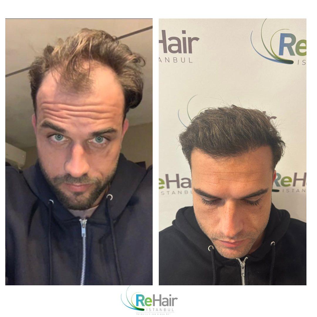 Haartransplantatie resultaat voor en na — 12 maanden