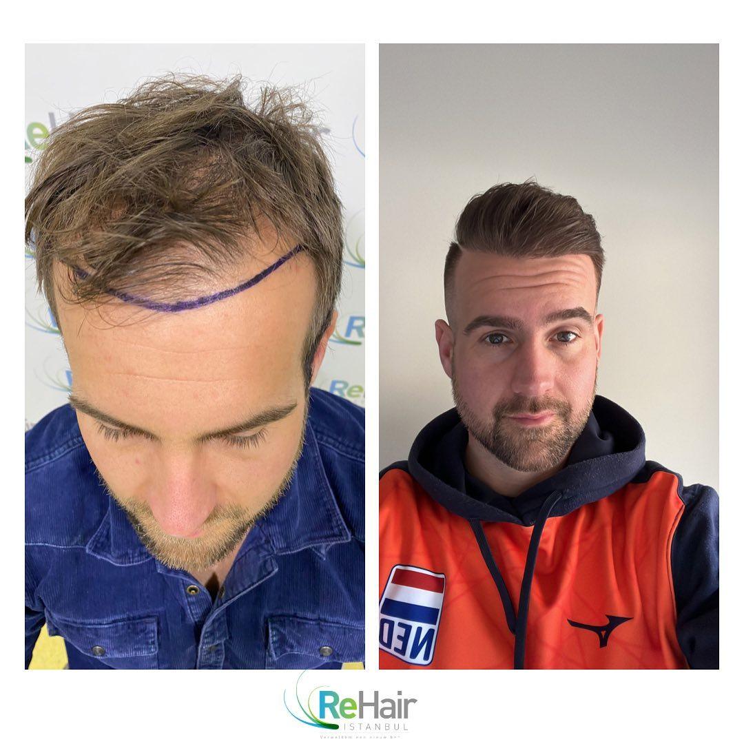 Haartransplantatie resultaat ReHair Istanbul