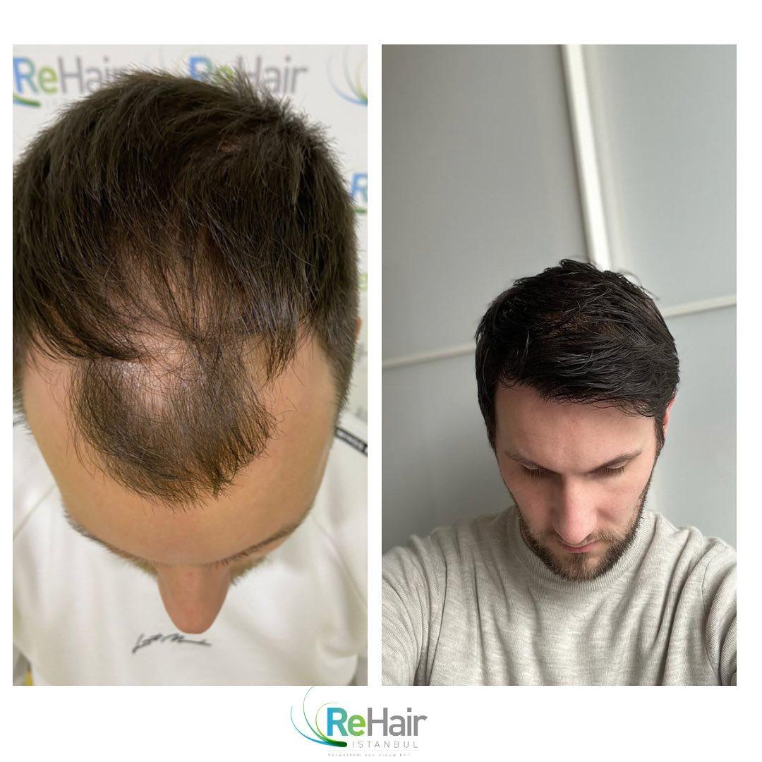 Haartransplantatie resultaat ReHair Istanbul