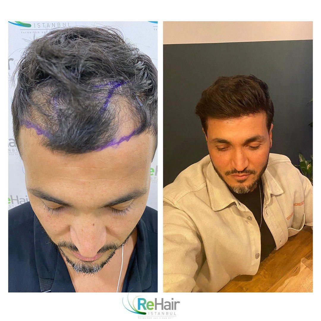 Haartransplantatie resultaat ReHair Istanbul