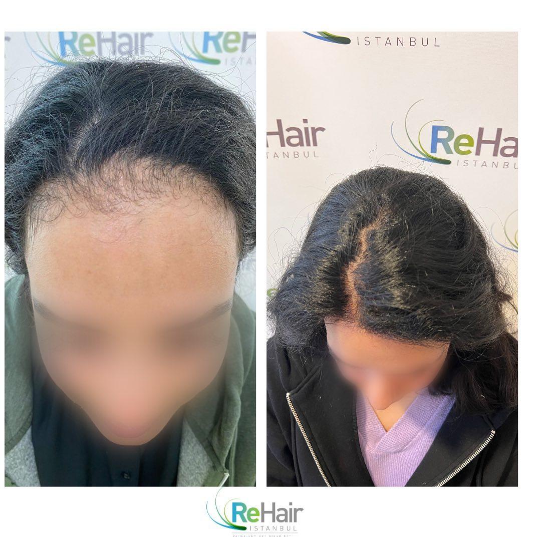 Haartransplantatie resultaat ReHair Istanbul