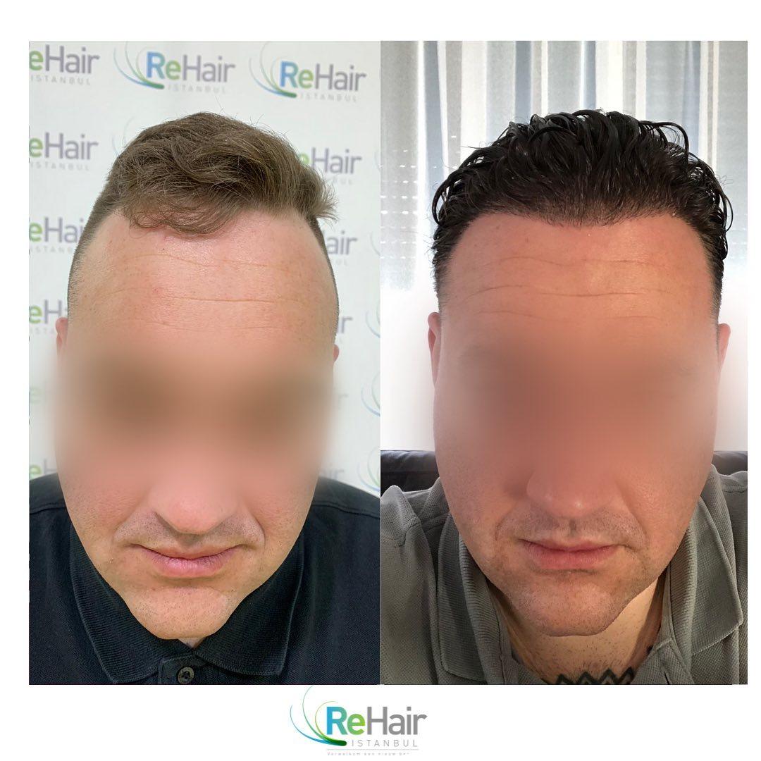 Haartransplantatie resultaat ReHair Istanbul