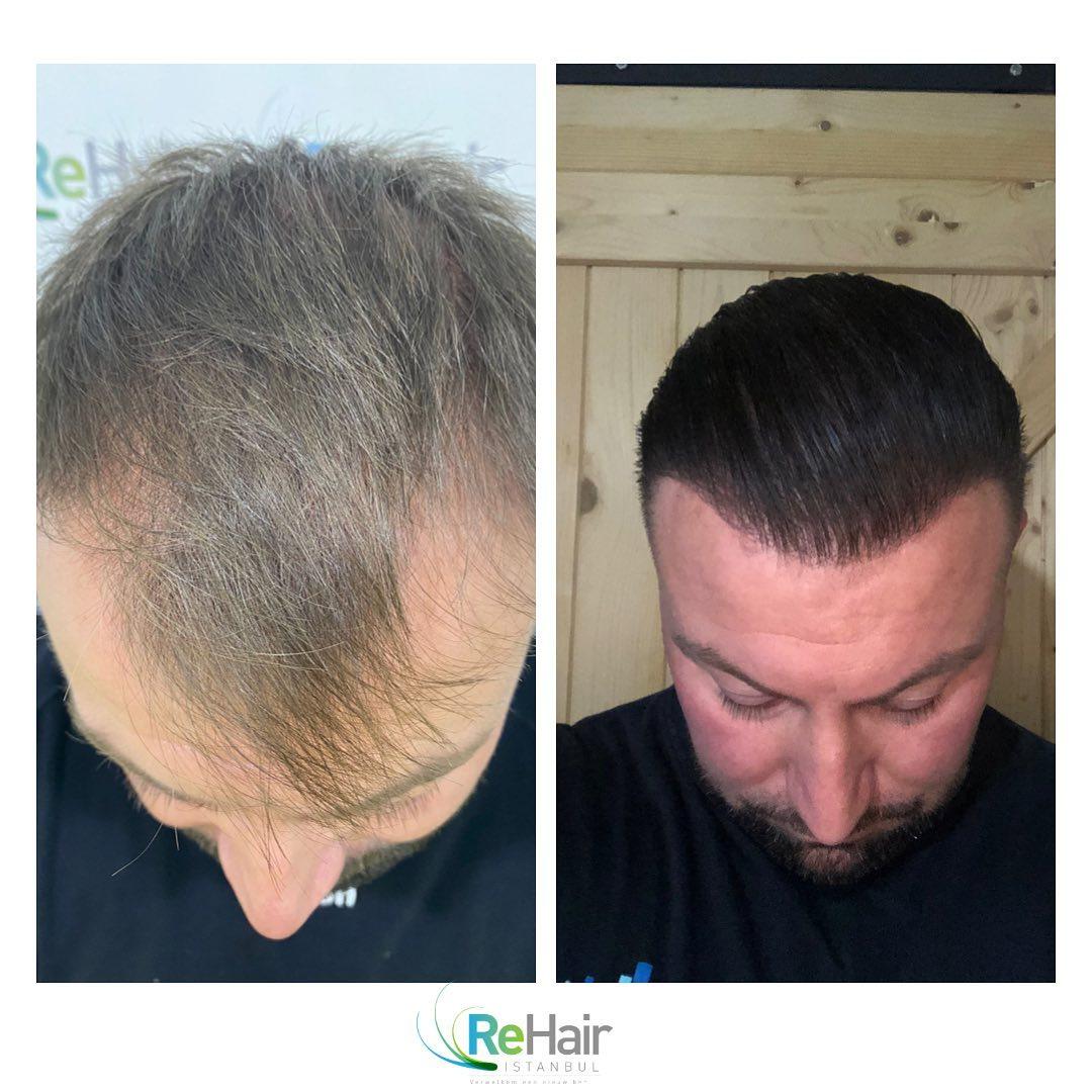 Haartransplantatie resultaat ReHair Istanbul